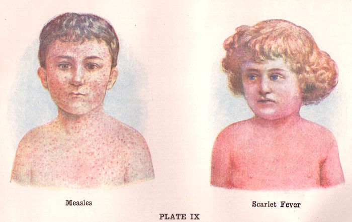 The Devastating Outbreaks of Scarlet Fever in the 19th Century: Unveiling the Historical Impact